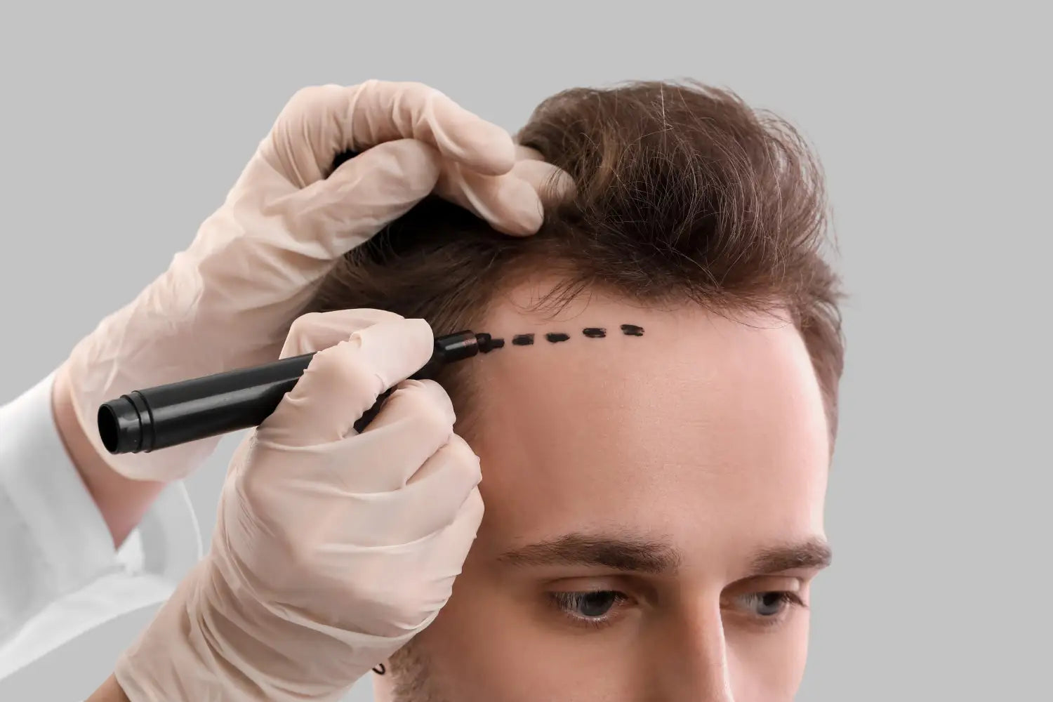 Hyperbaric Oxygen Therapy for Post-Hair Transplant Recovery