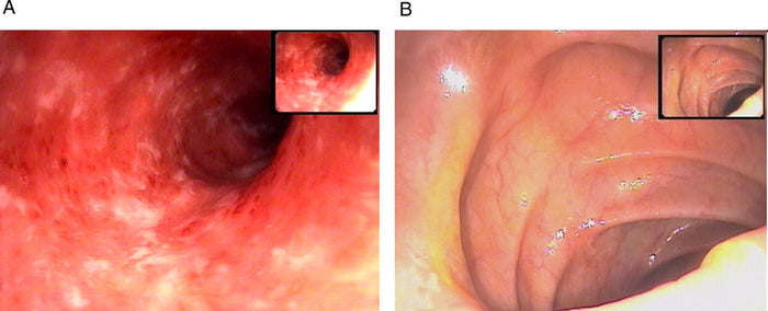 Inflammation and HBOT